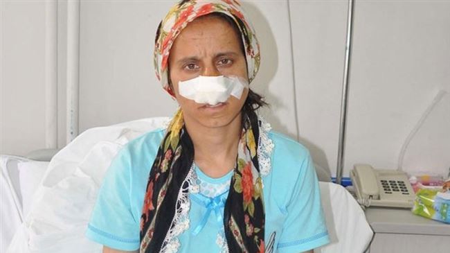 Eşi tarafından burnu kesildi