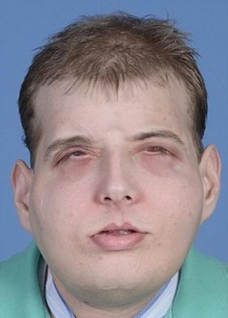 Hardison'a 26 yaşındaki David Rodebaugh'nun yüzü nakledildi.