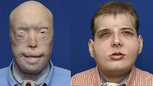 Patrick Hardison-yüz nakli-abd