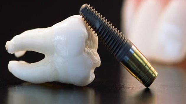 İmplant tedavisi yaptıracaklar dikkat!